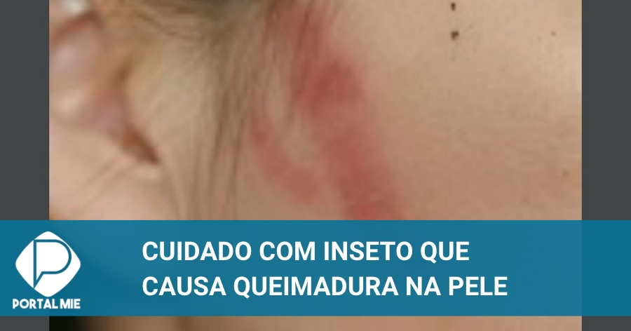 Inseto que causa erupção cutânea e inflamação como uma queimadura ...